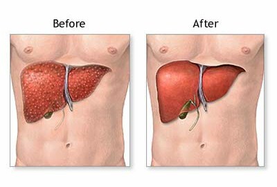 Liver transplant