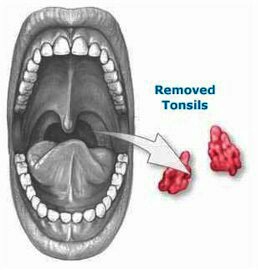 Tonsils